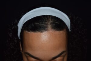 resolved shock hair loss 1 year after hairline lowering surgery